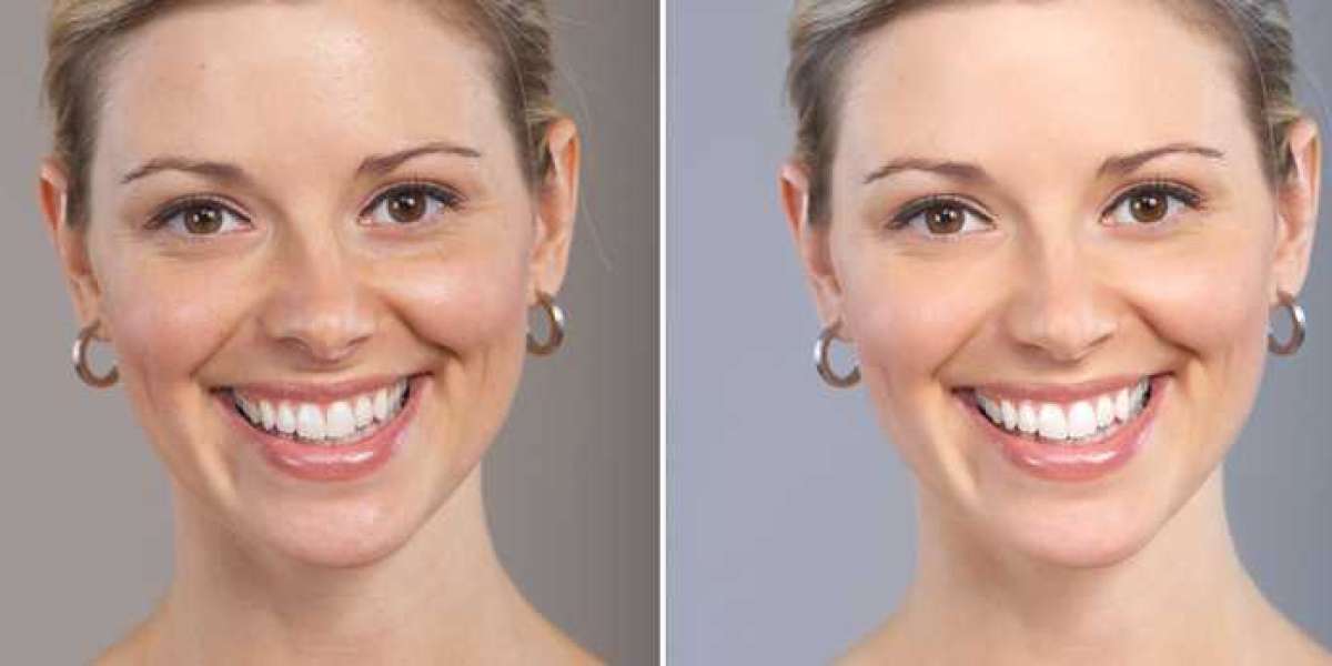 Skin Lightening Treatment in Delhi: Expert Solutions from Medlinks & Top Dermatologists in Gurgaon
