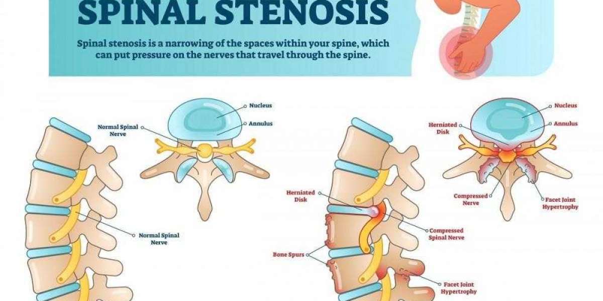 When to See a Spine Specialist for Spinal Stenosis in St. Louis (And What to Expect)