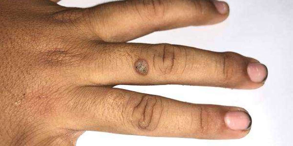 Warts Removal in Riyadh: Your Guide to Clearer-Looking Skin